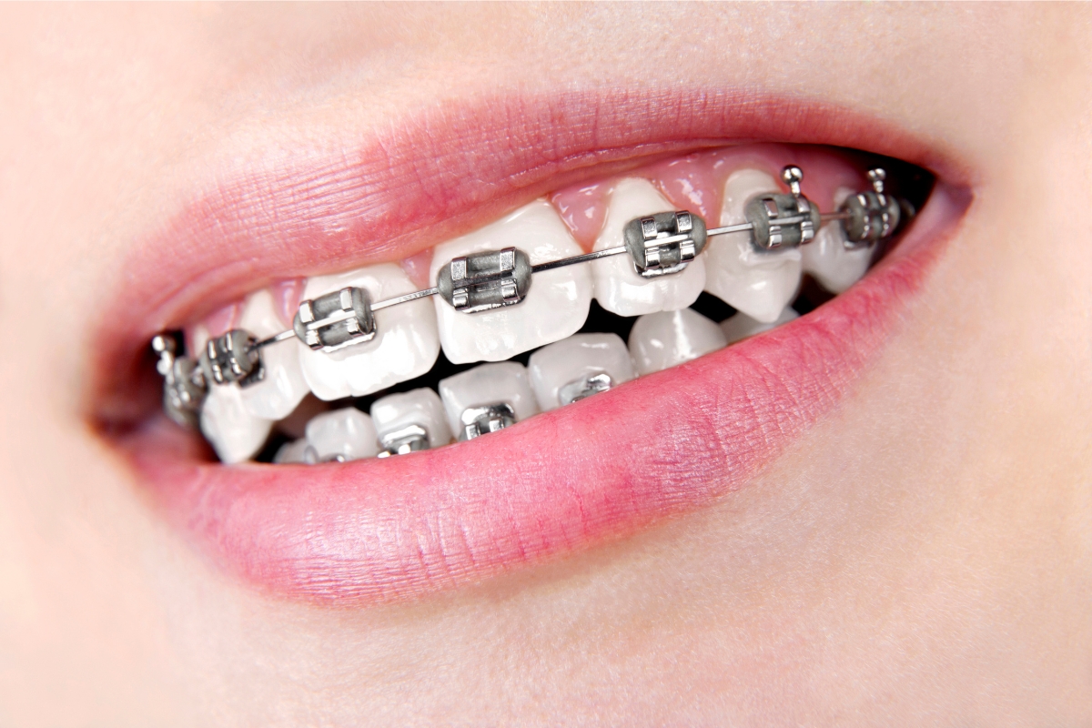 Best Braces Treatment in Khajaguda