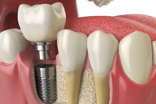 Advanced Orthodontics in Khajaguda Hyderabad