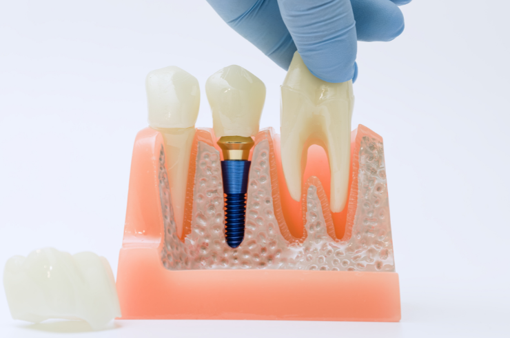 Dental Implants